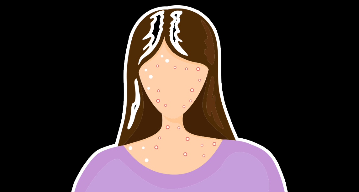 Nigeria Records 17 New Monkeypox Cases In 12 States