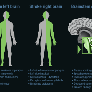Why Strokes Can Happen At Any Age And How To Prevent Them