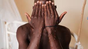 Breaking News: First Case of Mpox Clade 1b Strain Detected in London