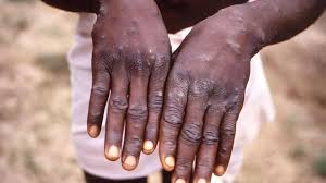 Mpox: More Cases of New Clade 1b Strain Detected in the UK