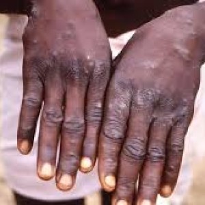 mpox-more-cases-of-new-clade-1b-strain-detected-in-the-uk